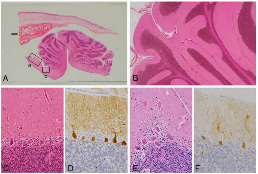 Γιατροί βρήκαν μίνι εγκέφαλο μέσα στην ωοθήκη ενός κοριτσιού 16 ετών Γιατροί βρήκαν μίνι εγκέφαλο μέσα στην ωοθήκη ενός κοριτσιού 16 ετών