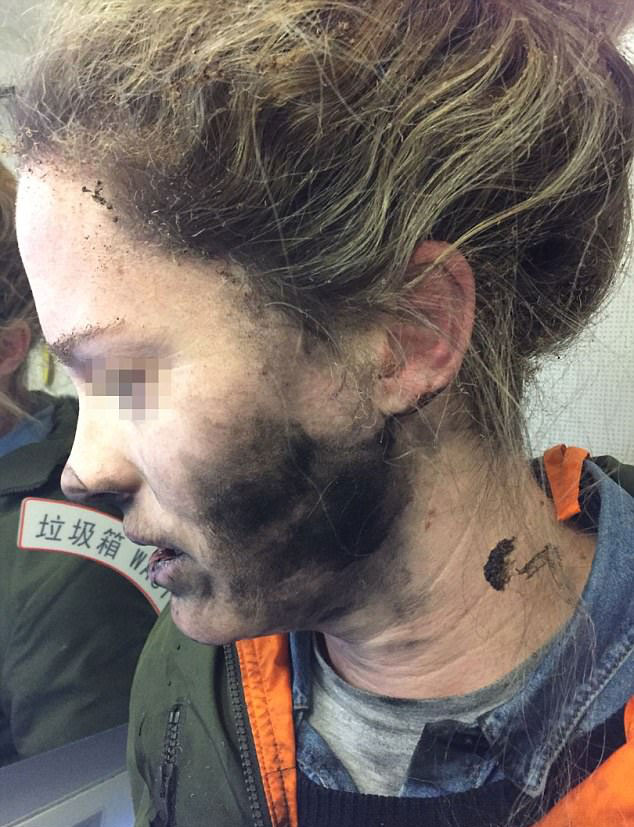 Κάηκε το πρόσωπό της μέσα στο αεροπλάνο όταν εξερράγησαν τα ακουστικά της