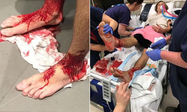 Αιμοβόρες «ψείρες της θάλασσας» κατέφαγαν τα πόδια 16χρονου