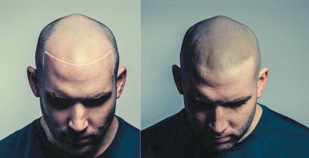 Scalp Cosmedic Tattoo