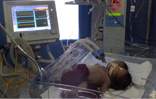 σιαμαία με δύο κεφάλια και κοινό κορμό 