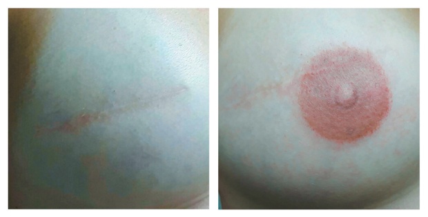 Ιατρικό τατουάζ θηλής