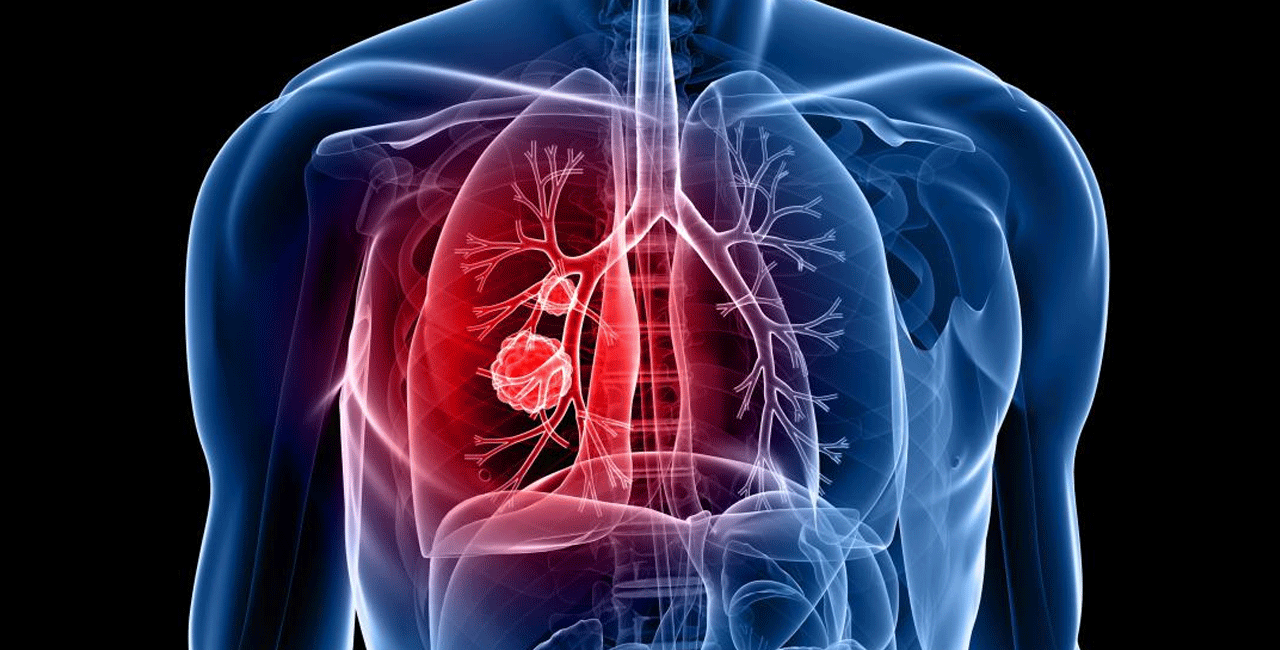 lung-cancer23.gif