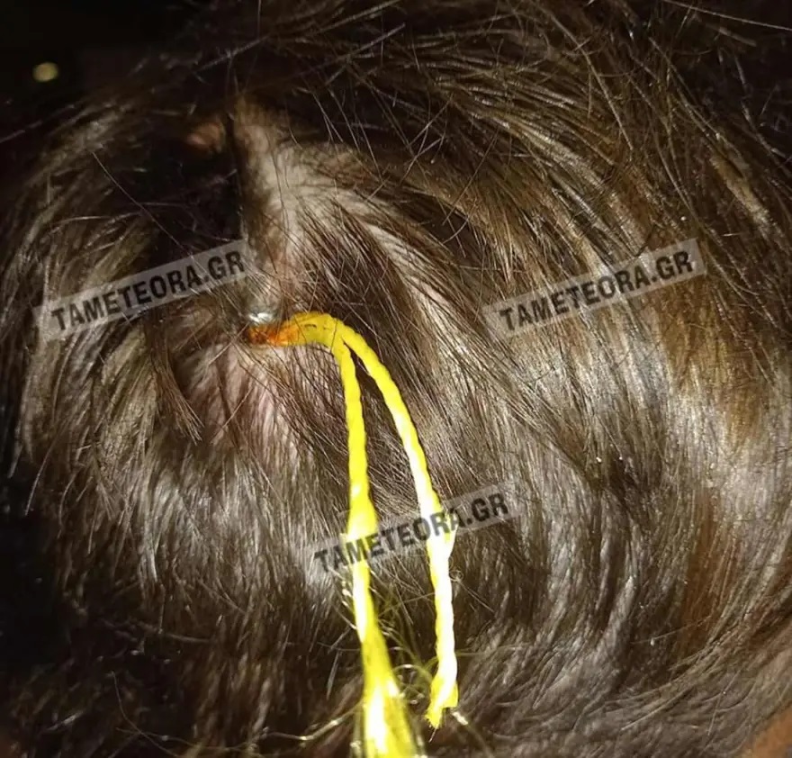 Καλαμπάκα: Καρφί 5 εκατοστών σφηνώθηκε στο κεφάλι άνδρα